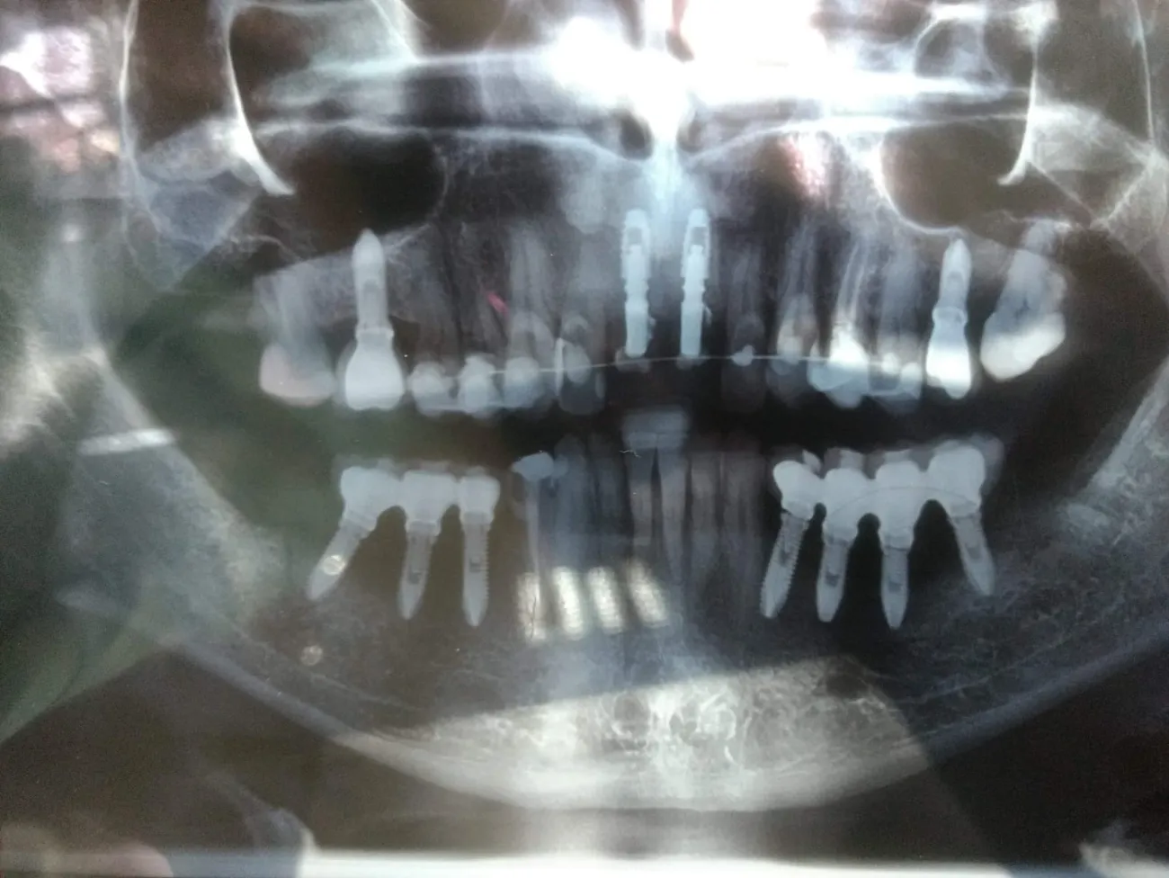 Radiografia panorâmica com implantes