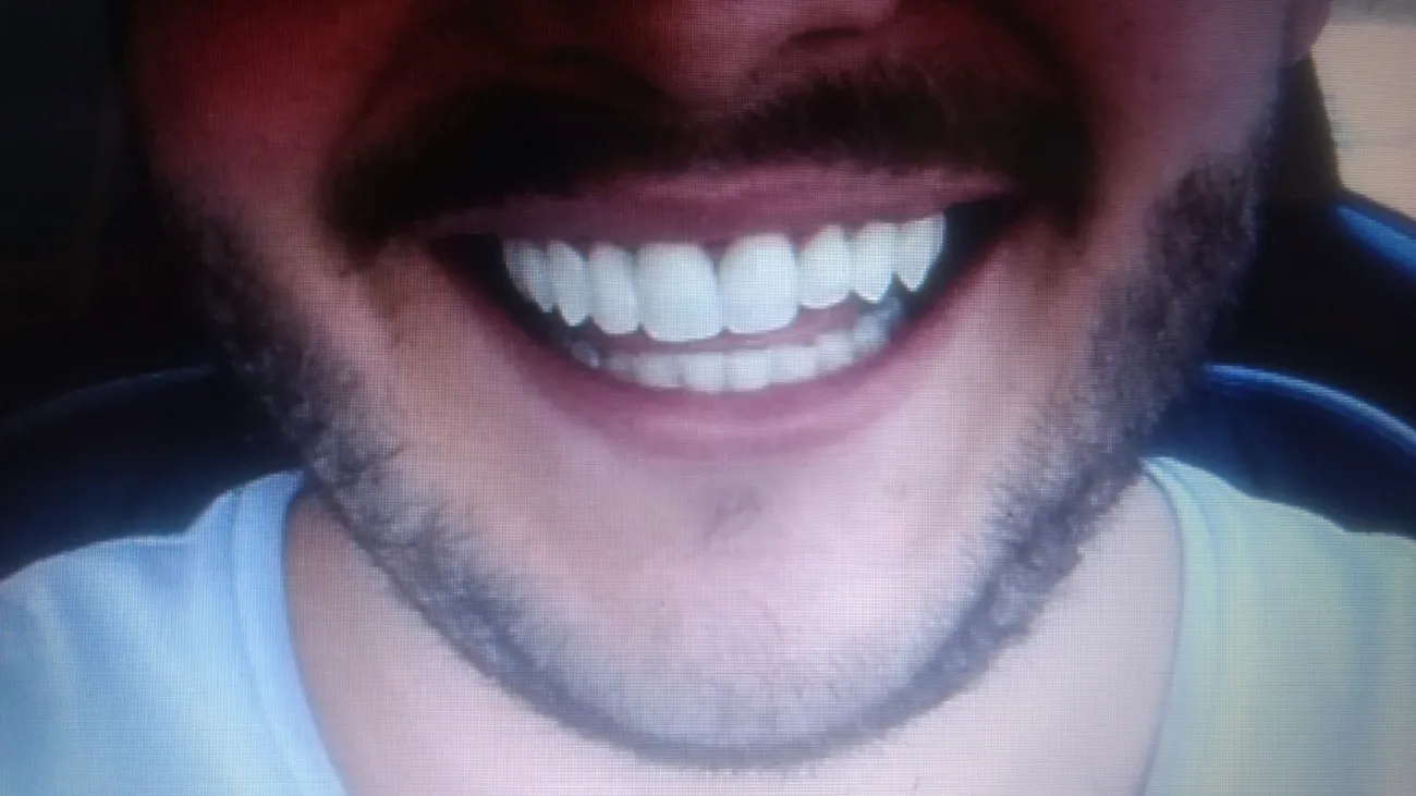 Sorriso de paciente com barba depois do tratamento