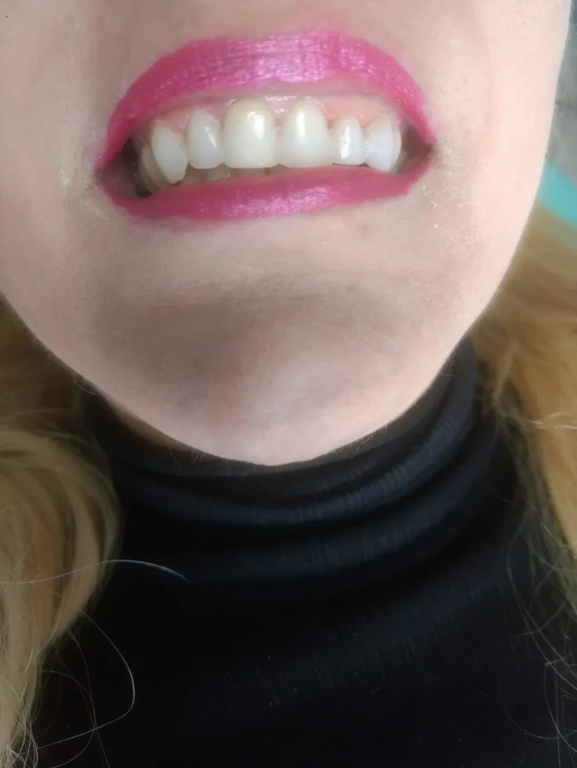 Sorriso de paciente com batom rosa depois do tratamento
