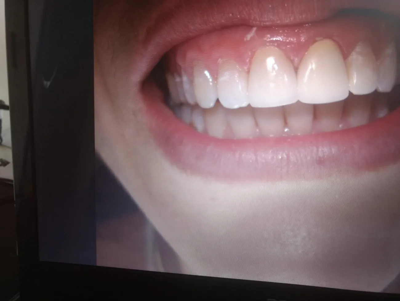 Sorriso com dentes claros e alinhados